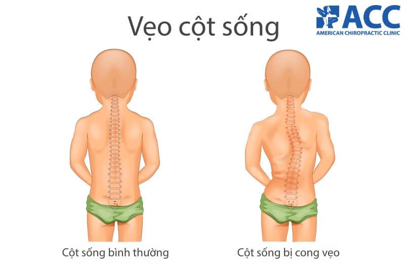 vẹo cột sống là gì