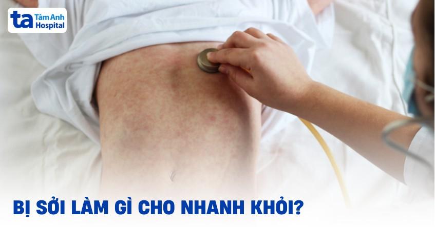 bị sởi làm gì cho nhanh khỏi