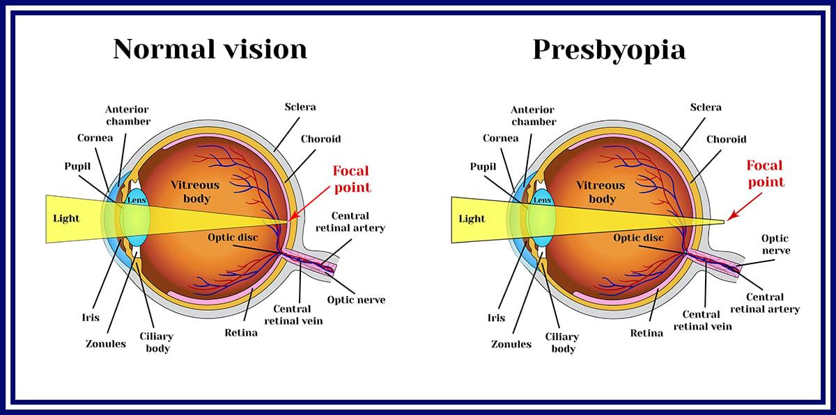 สายตายาวตามวัยแก้ได้ด้วย FemtoLASIK Presbyond