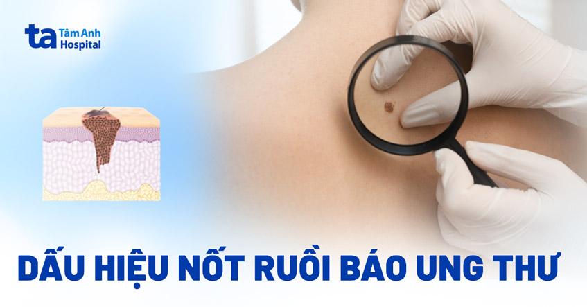 nốt ruồi báo ung thư